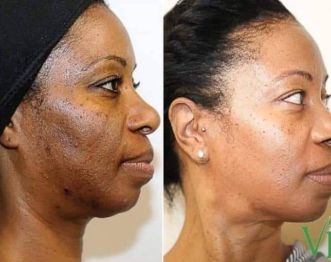 Kojic Acid & Turmeric Soap